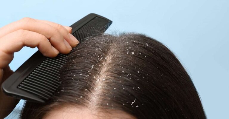 Dream About Dandruff