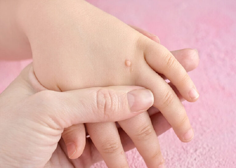 Dream about Warts