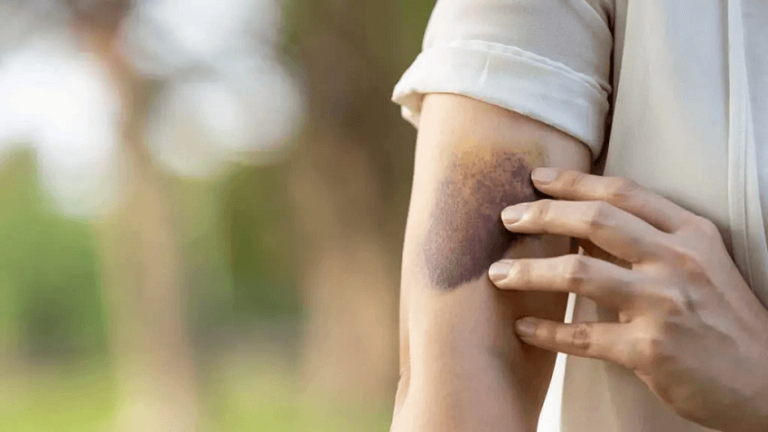 Dream of Bruises