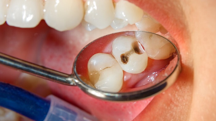 Dream of cavities in the mouth