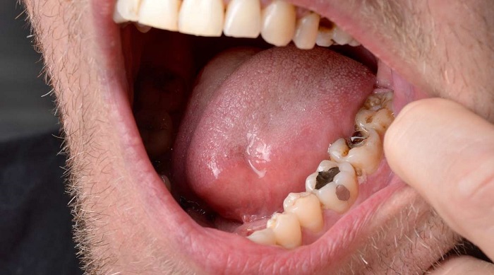 Dream of decayed and broken teeth