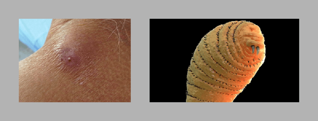 Dream of larvae in the body