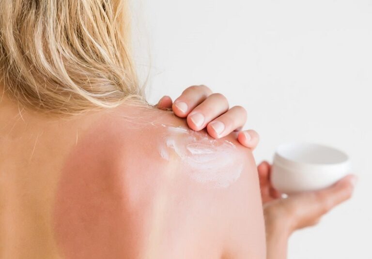 Dream of sunburn